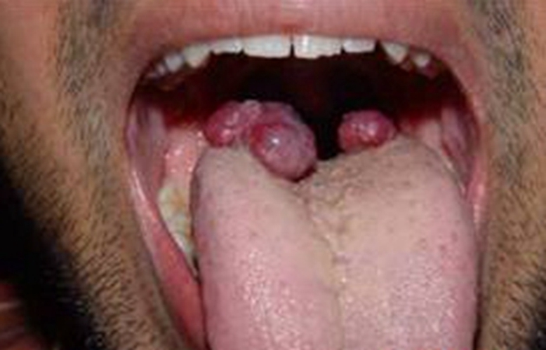 舌头下面长血管瘤图片