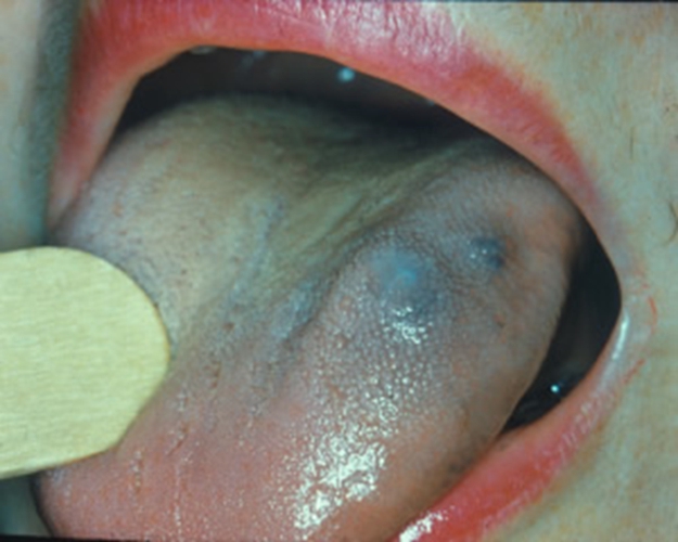 舌头有血管瘤图片图片