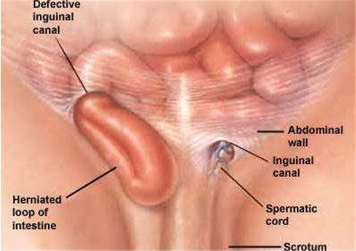 小儿疝气解说图片