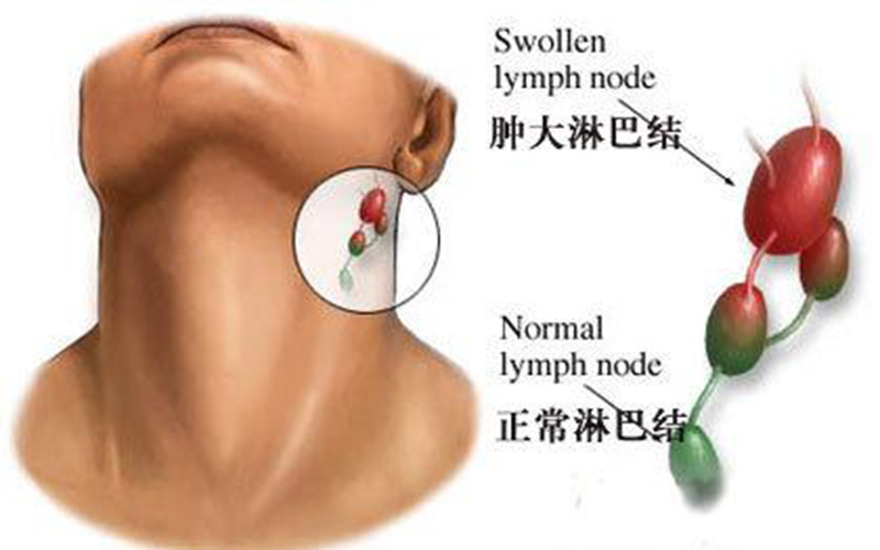 颈部淋巴结肿大的症状