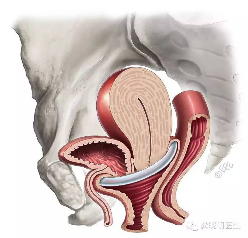 子宫脱垂阴道壁膨出了怎么办?