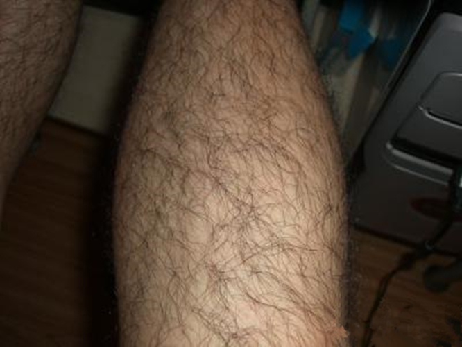 女性腿部多毛症图片