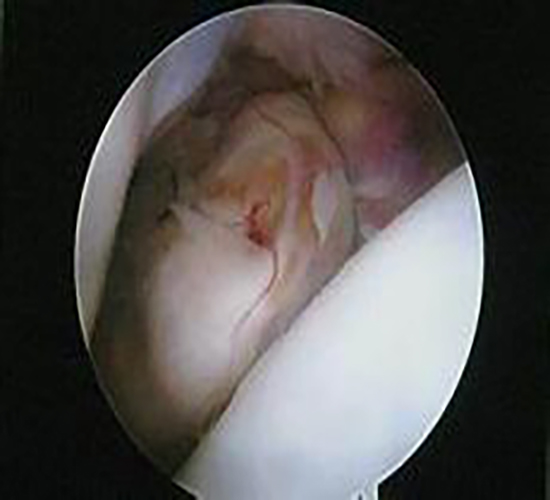 滑膜肉瘤图片症状图片
