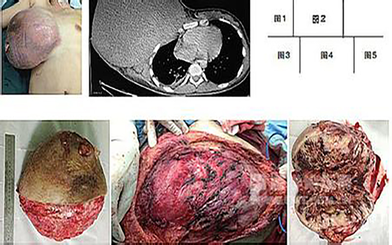 滑膜肉瘤发病率图片