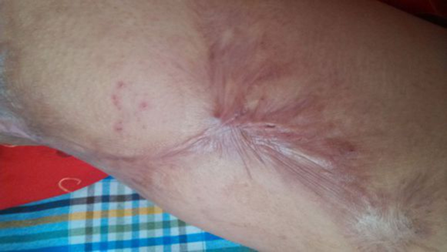 肛裂术后20天伤口图片图片