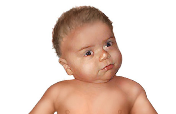 宝宝痉挛性斜颈的图片