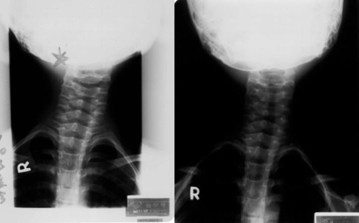 痉挛性斜颈的X光图片
