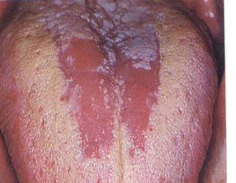 男人感染霉菌的症状图片