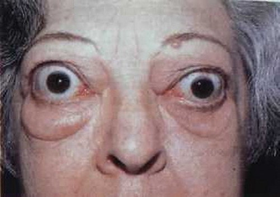 甲亢患者的眼睛图片图片