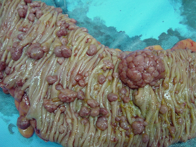 肠息肉图片肠癌图片