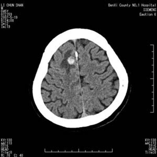 肺腺癌脑转移的图片