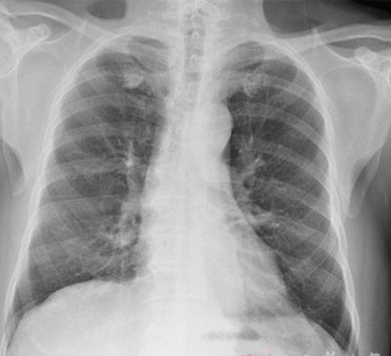 浸润性肺腺癌早期症状图片