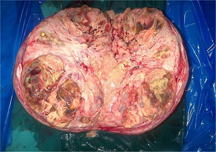 取出的巨大腹部肿瘤图片