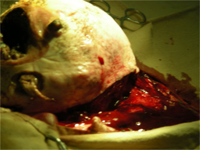 睾丸肿瘤图片