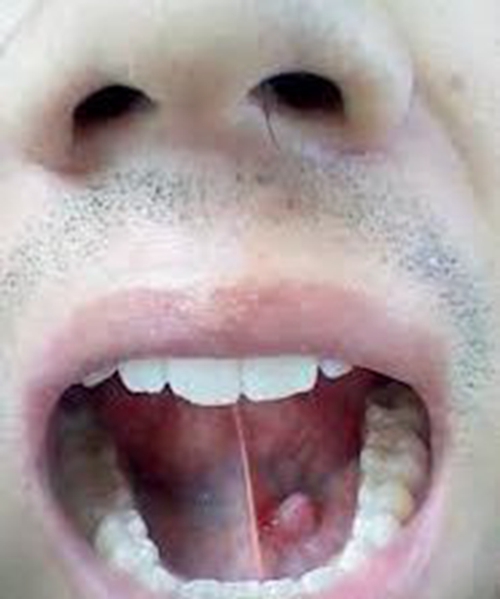 舌头下面囊肿图片图片