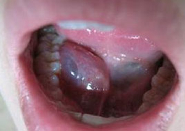  舌下腺囊肿穿刺图片