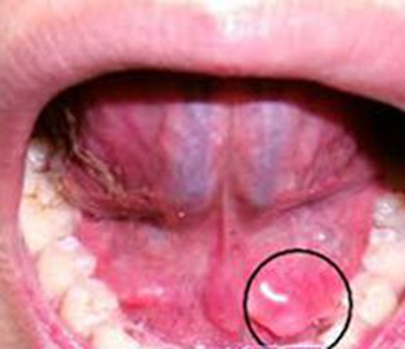  舌下腺囊肿刺破图片