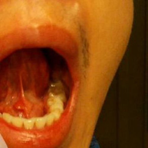 舌下腺肿瘤图片真人图片