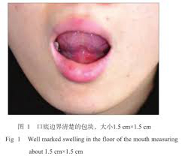  舌下腺囊肿儿童图片