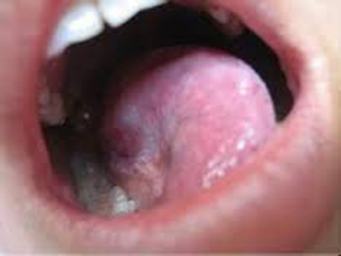  舌下腺囊肿分泌酸液图片