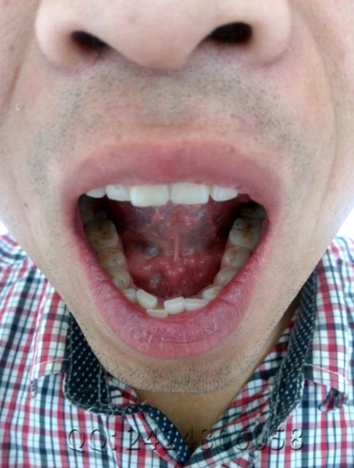 舌下腺囊肿图片 症状图片