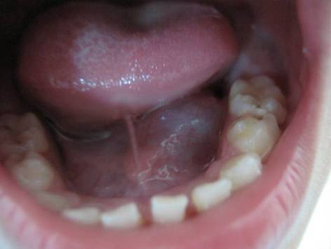 舌骨管囊肿图片
