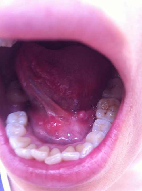 舌头下疙瘩图片