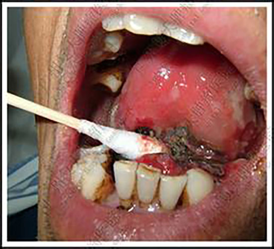 舌头鳞状细胞癌图片图片