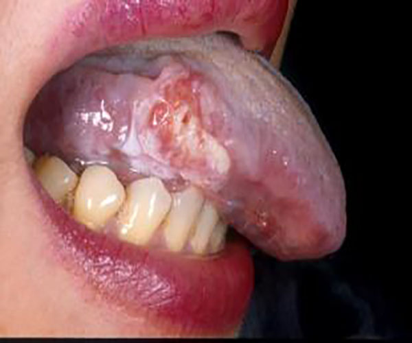 舌癌和溃疡的区别图片