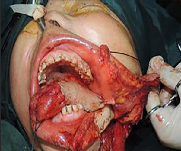 舌头肿瘤图片图片
