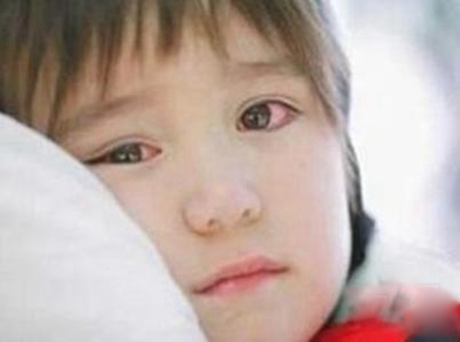 儿童双眼过敏性结膜炎图片