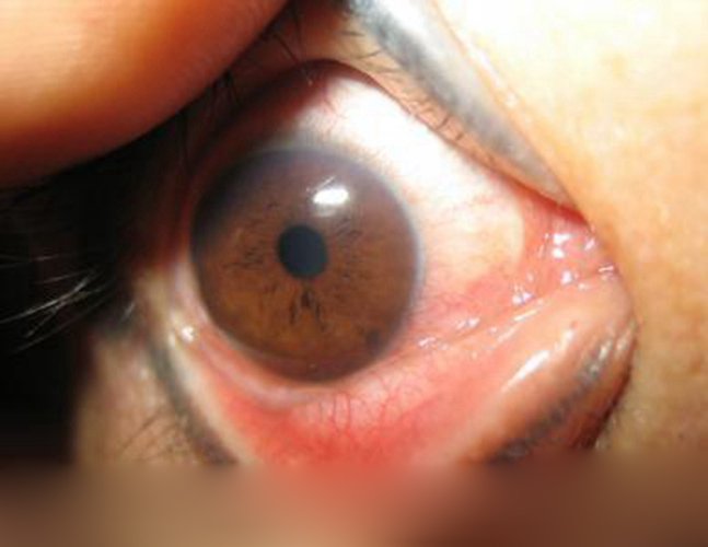 过敏性结膜炎眼睑病症图片