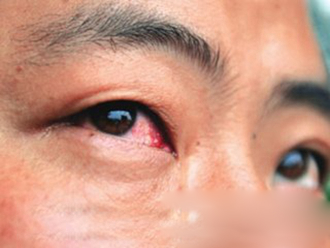 过敏性结膜炎右眼充血状图片