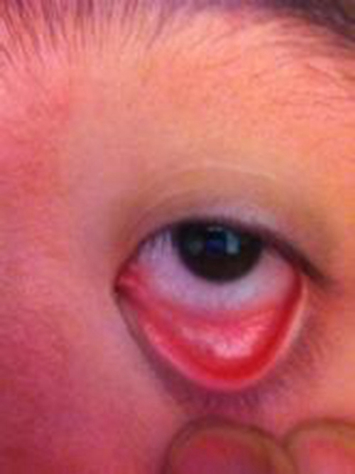 过敏性结膜炎左眼下眼睑图片
