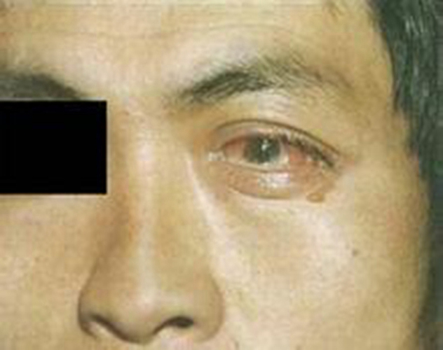 男性左眼过敏性结膜炎图片
