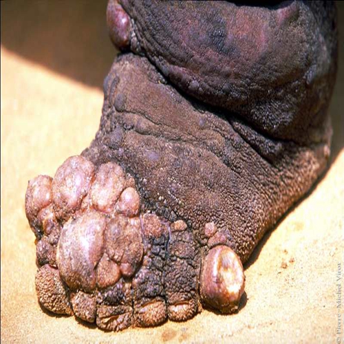 麻风病引起脚趾病变的图片