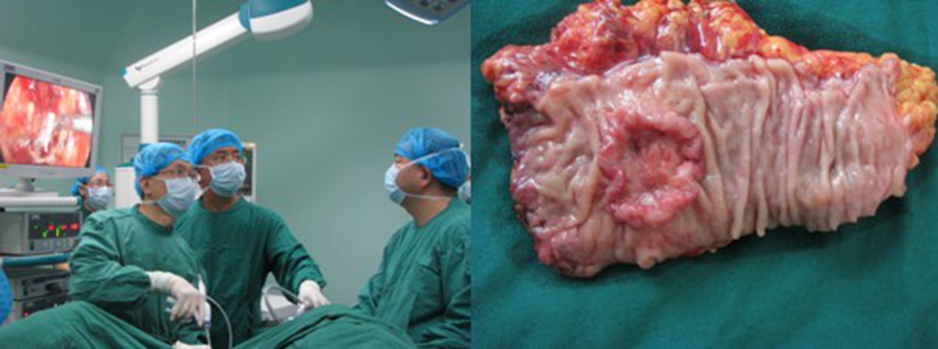 直肠癌保肛手术的图片