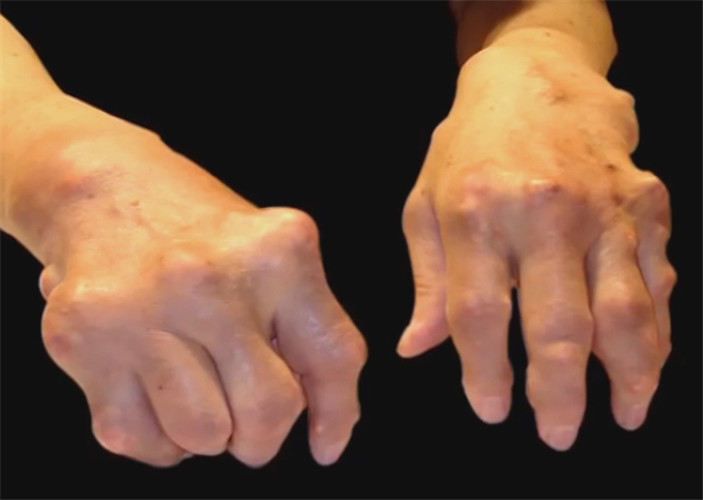 类风湿性关节炎双手关节图片