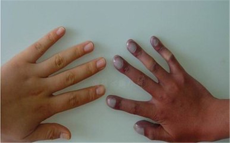 双手类风湿性关节炎症状图片