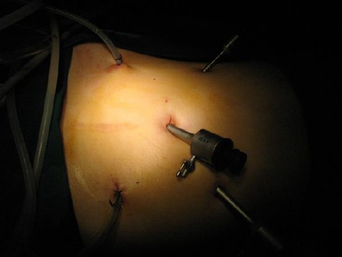 切口手术—腹腔镜下全直肠癌图片