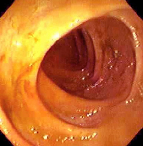 肛管直肠癌的图片