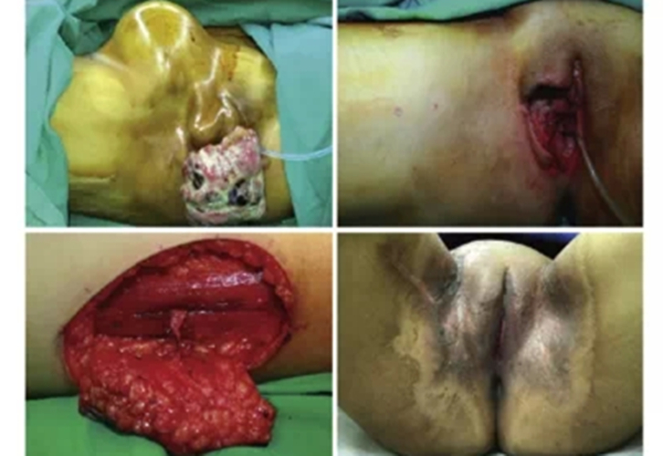 外阴癌手术过程图片