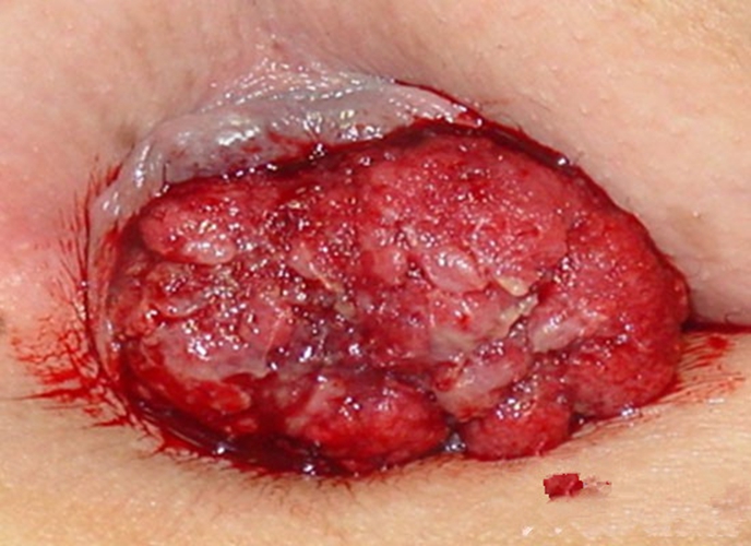 女性肛门息肉的症状图片