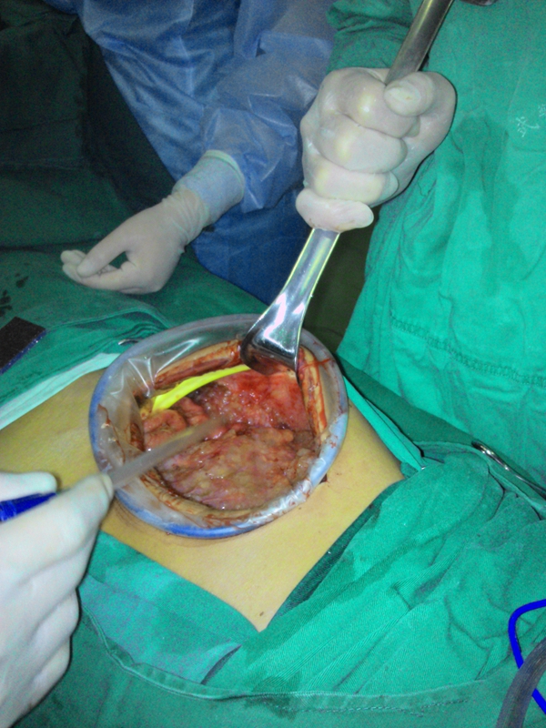 肠肿瘤手术真实图片
