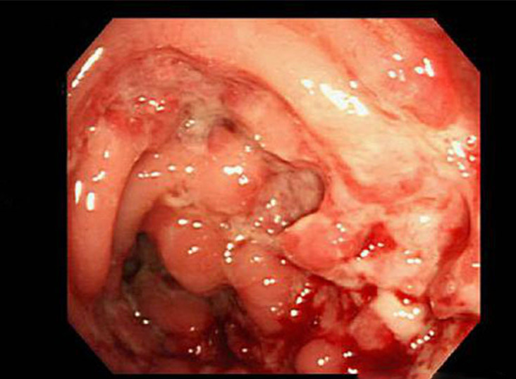 肠道肿瘤长什么样图片图片