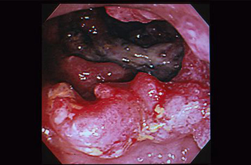 肠肿瘤晚期图片