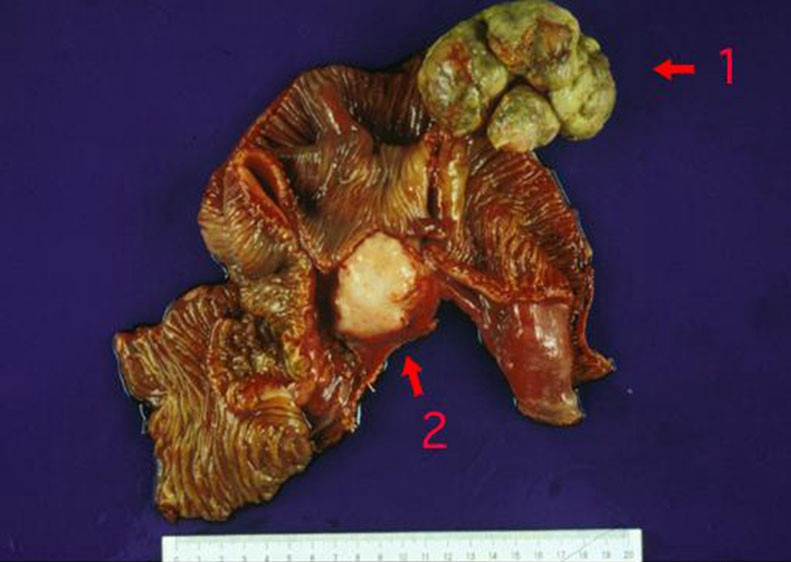 肠肿瘤早期的实物图