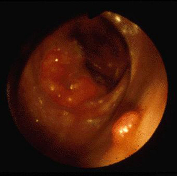 小肠肠肿瘤观察病变图片