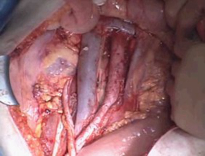 直肠肿瘤恶性肠镜图片