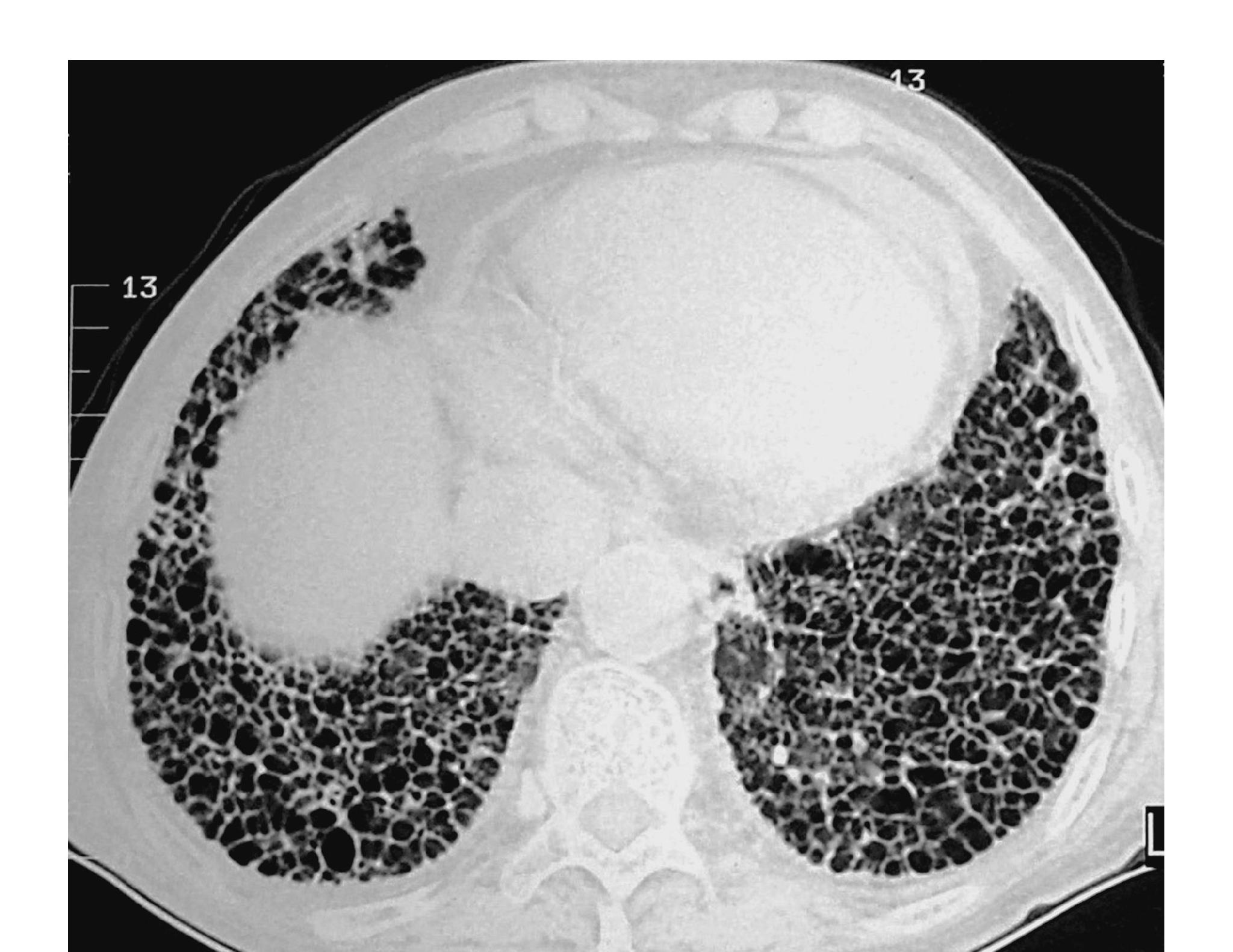 肺结核ct片图片图解,正常肺与肺结核t图片,肺结核图片和正常图片(第5页)_大山谷图库